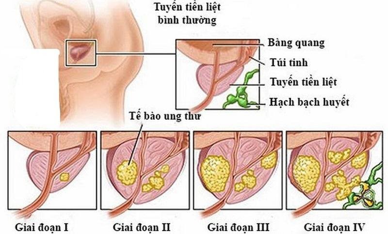 Hình minh họa các giai đoạn của ung thư tiền liệt tuyến